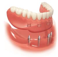 Dental Implants Malvern - Citra Dental Group image 3